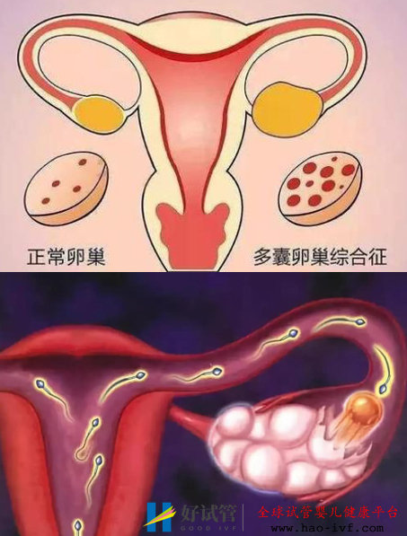 多囊卵巢综合症做试管婴儿要注意什么?(图1) 多囊卵巢综合症做试管婴儿要注意什么?(图1)