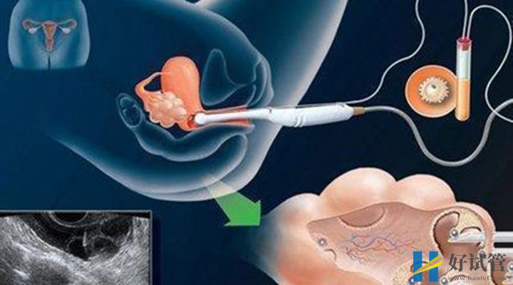 女性卵泡不破不能做试管,找准原因治疗方为上策(图2) 卵泡穿刺可以帮助卵子排出
